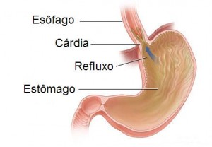 Dieta para Refluxo