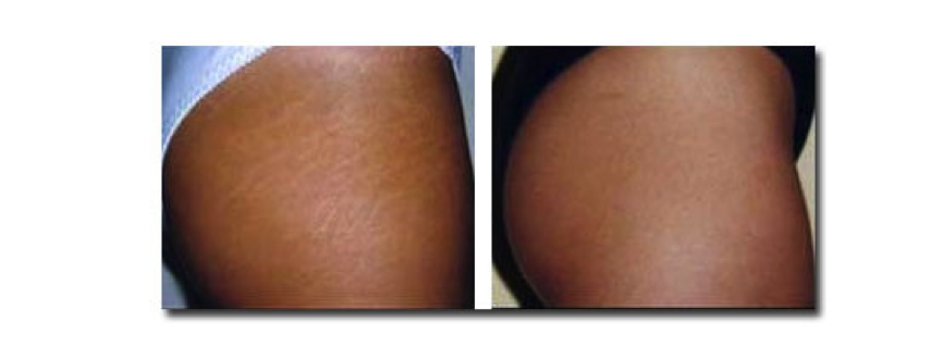 Mesoterapia para adelgazar abdomen