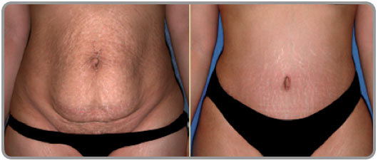 abdominoplastia circunferencial