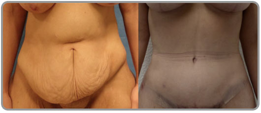 abdominoplastia completa