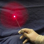 laser-lipo