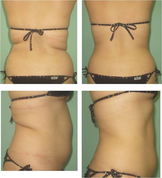 Quanto Custa Uma Lipoescultura? MundoBoaForma