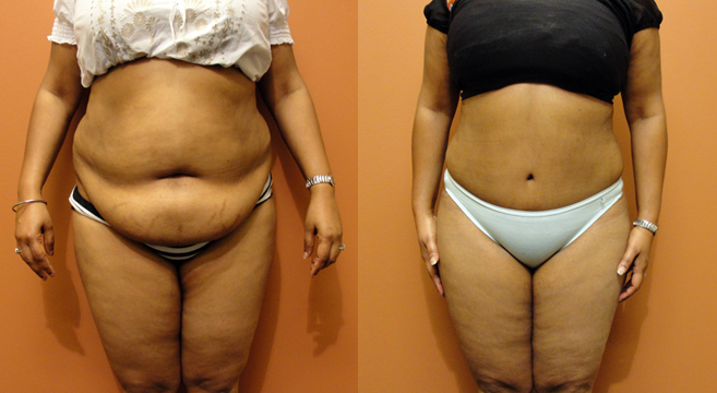 38+ Cicatriz Abdominoplastia Antes E Depois Pics