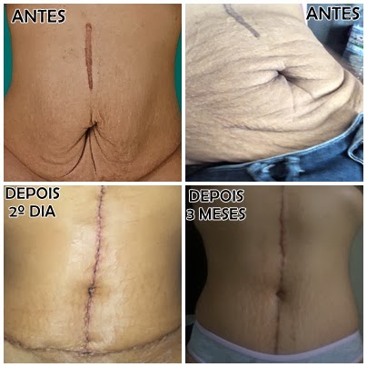 Cirurgia para retirada de pele da barriga