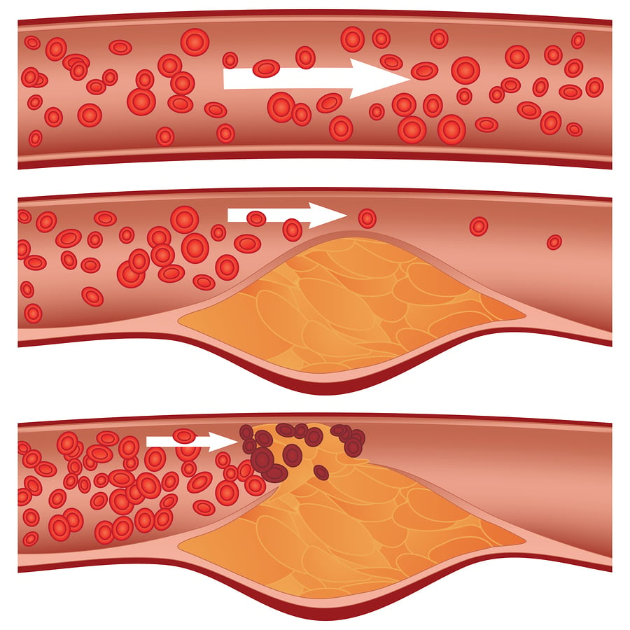 artéria obstruída pelo colesterol