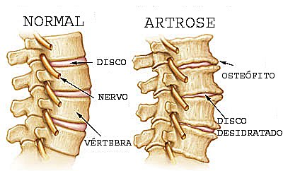 Espondilose