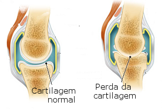 osteoartrite