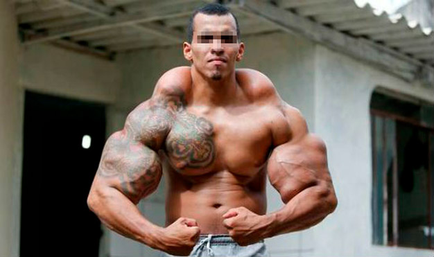 pessoa com assimetria muscular depois de aplicado o synthol