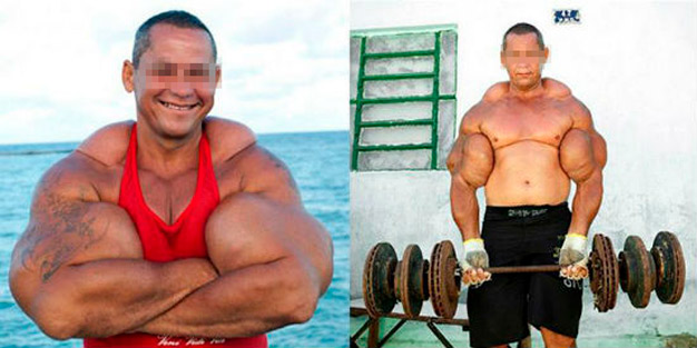 pessoa com músculos inchados depois de aplicado o synthol