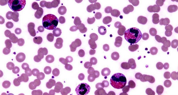 Nível de Eosinófilos Alto - O Que Significa? - MundoBoaForma.com.br