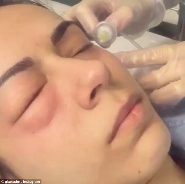Carboxiterapia resultados antes e depois