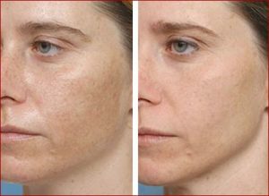 Peeling Ultrassônico - O Que é, Antes e Depois, Para Que Serve e Dicas ...