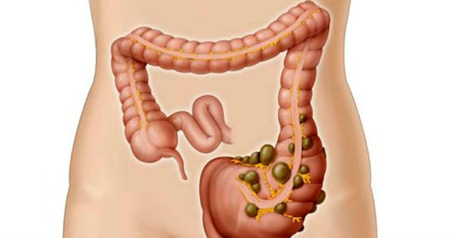 diverticulitis intestino enjuto seram