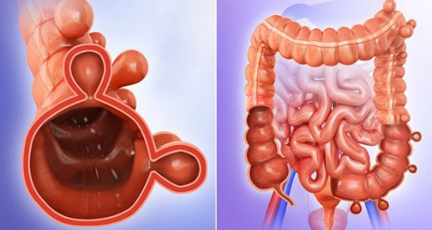Diverticulite Aguda - O Que é, Sintomas, Dieta e Tratamento ...