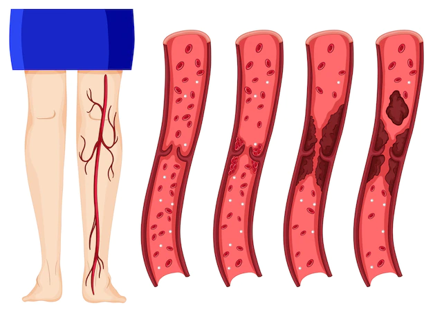 trombos de sangue nas veias