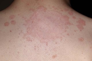 Camaragibe Agora - 🔴 Como identificar e tratar a Impingem A impingem,  conhecida cientificamente como Tinea corporis, é doença de pele causada por  fungos, que provoca o surgimento de pequenas vesículas de