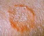 Camaragibe Agora - 🔴 Como identificar e tratar a Impingem A impingem,  conhecida cientificamente como Tinea corporis, é doença de pele causada por  fungos, que provoca o surgimento de pequenas vesículas de