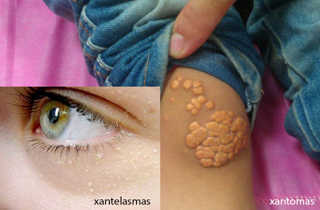 xantelasma e xantoma sintomas de triglicerídeos alto