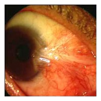 Cirurgia de Pterígio caso 2 antes