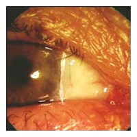 Cirurgia de Pterígio