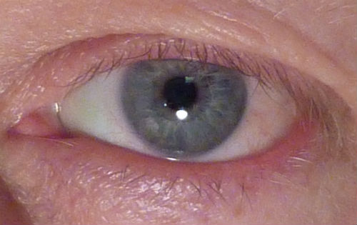 Cirurgia de Pterígio depois
