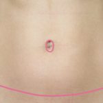 Cicatriz de abdominoplastia