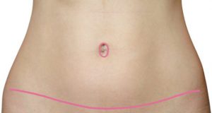 Cicatriz de abdominoplastia