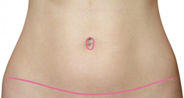 Cicatriz de Abdominoplastia - Cuidados Importantes ...