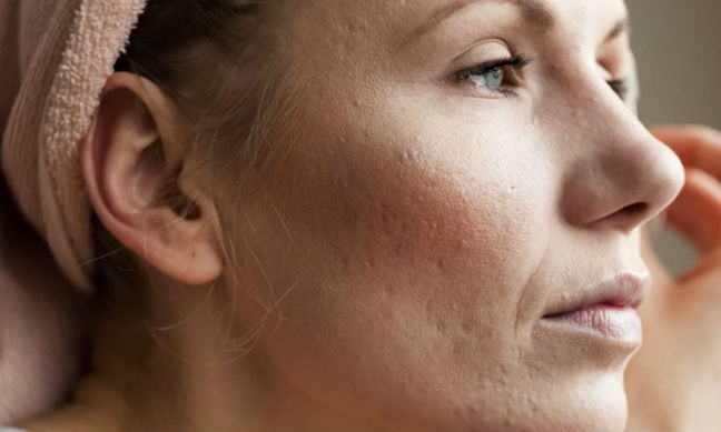 Eliminar marcas acne