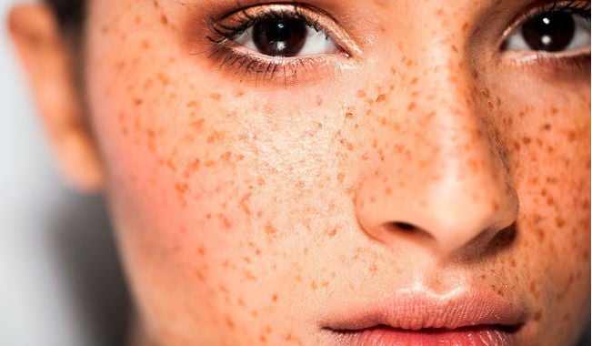 tipos de melasma