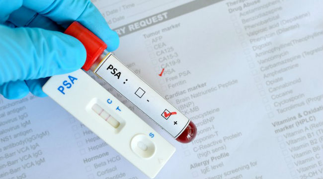 prostata congestionata cause prostata congestionata cause