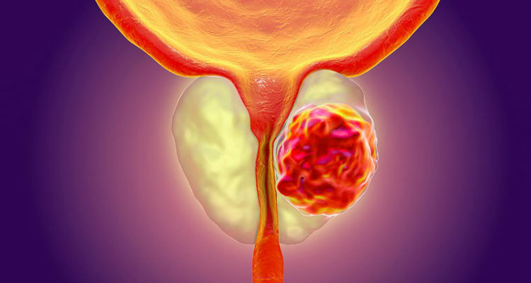 adenocarcinoma de próstata alteración genética de la