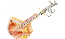 agrandamiento vascular de la próstata agrandamiento vascular de la próstata