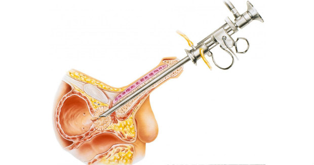 cirurgia prostata impotencia