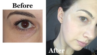 Relleno de círculos oscuros: antes y después, resultados y testimonios 2 Relleno de círculos oscuros: antes y después, resultados y testimonios 2