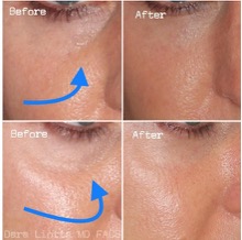 Relleno de círculos oscuros: antes y después, resultados y testimonios 4 Relleno de círculos oscuros: antes y después, resultados y testimonios 4