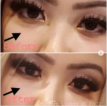 Relleno de círculos oscuros: antes y después, resultados y testimonios 6 Relleno de círculos oscuros: antes y después, resultados y testimonios 6
