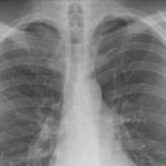 Embolia pulmonar