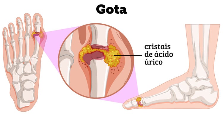 ilustração da gota