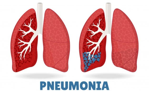 pneumonia ilustração
