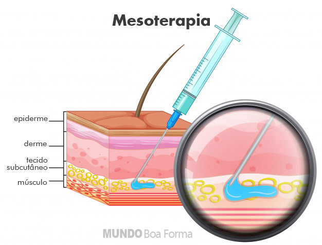 mesoterapia