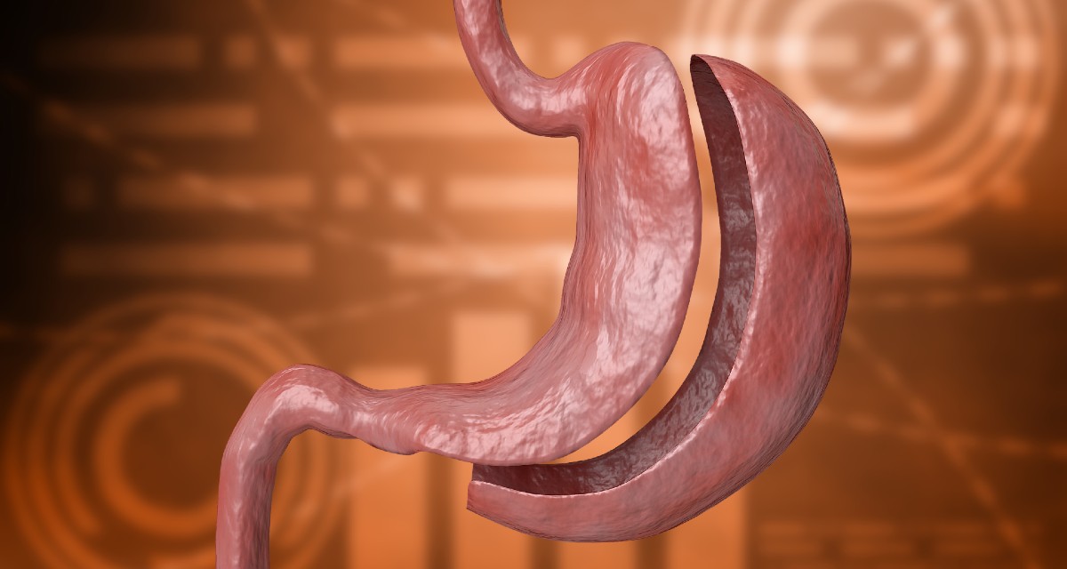 Bariátrica sleeve O que é e para que serve MundoBoaForma