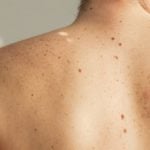 Câncer de pele - Sintomas e tratamento