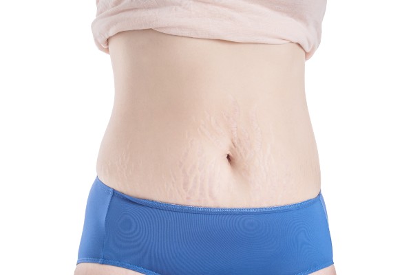estrias na barriga