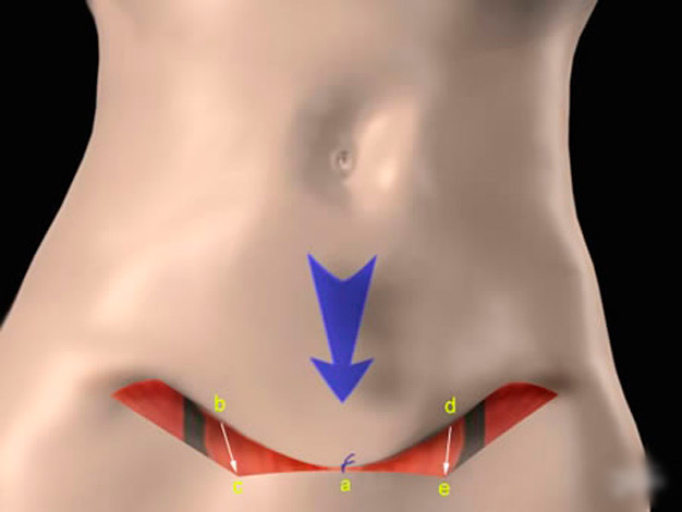 ilustração abdominoplastia