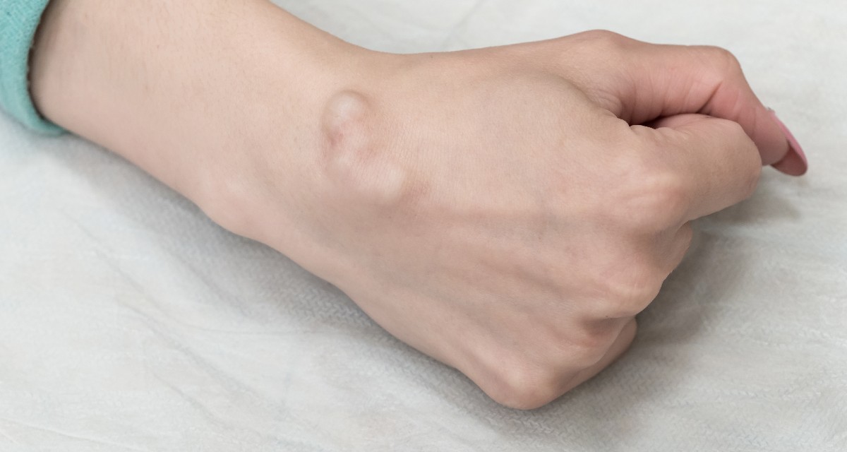 Cisto sebáceo - O que é, sintomas e como tratar - MundoBoaForma