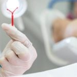 Dispositivo intrauterino (DIU) - Como funciona e benefícios