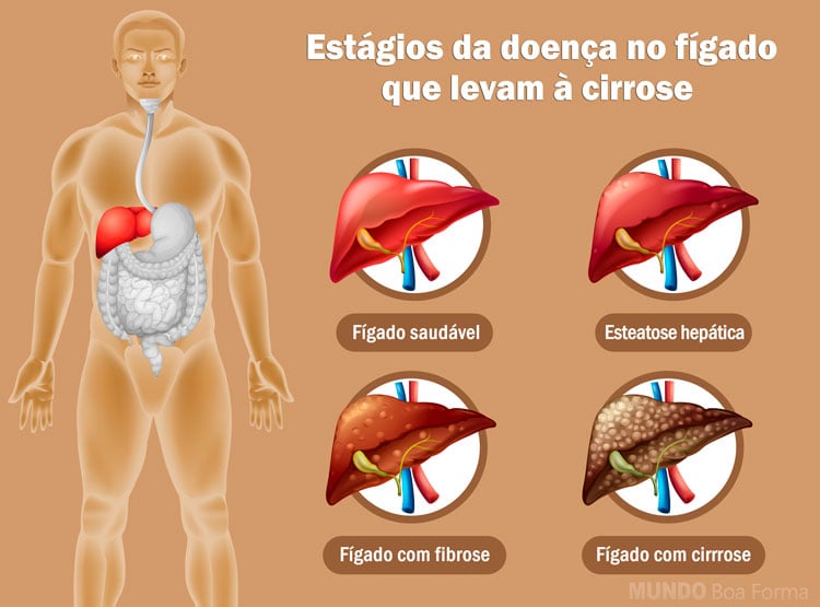 estágios do fígado até chegar na cirrose