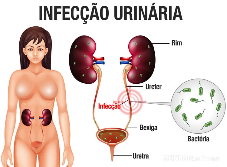 infográfico infecção urinária
