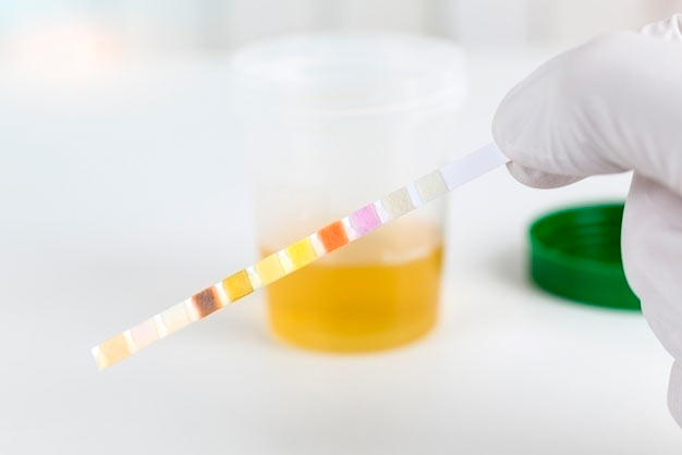 teste de urina para corpos cetônicos